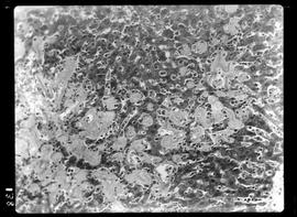 Fotomicrografia de degeneraçao do tecido conjuntivo (Hanseníase) fígado 180x