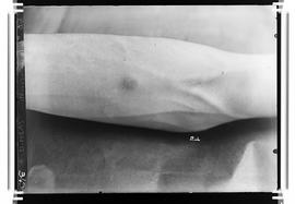 Doente - lesão no braço