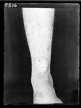 Doente - lesão na perna