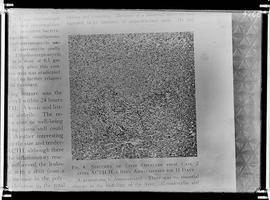 Reprodução de fotomicrografia em publicação com a seguinte legenda "Specimen of liver obtain...