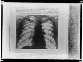 Reprodução de  radiografia (tórax) em publicação com a seguinte legenda: Ganglio para traqueal de...