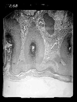 Fotomicrografia de corte histológico de lesão de Lupus eritematoso discóide situada na face
