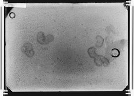Fotomicrografia - Actinomicose grãos de pús de mecetons
