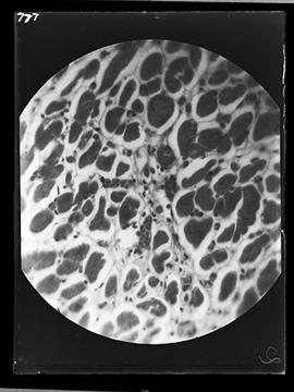 Fotomicrografia - Doença de Chagas (miocardite crônica) Deolinda OC 4X Obj 7