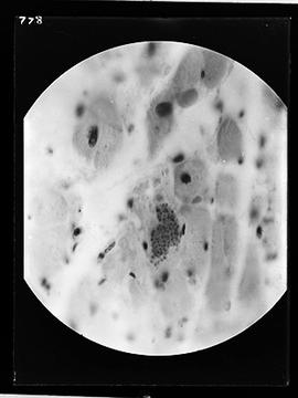 Fotomicrografia - Doença de Chagas (miocardite crônica), Vargem OC1. 4X Obj imersão