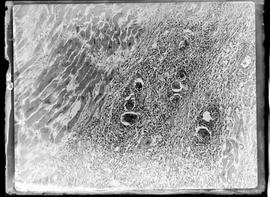 Fotomicrografia de ovos de esquistossoma no miocárdio com aumento de 100 vezes - Esquistossomose