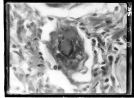 Fotomicrografia de ovos de esquistossoma no miocárdio com aumento de 1100 vezes - Esquistossomose