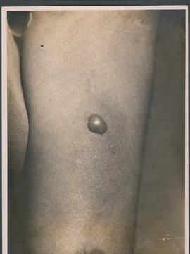 Foto de cicatriz deixada pela vacina BCG