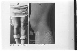 Doente com lepra no joelho na primeira imagem, na segunda, com o joelho reestabelecido