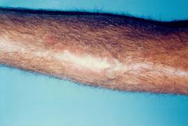 Lesões causadas pela Leishmaniose em humanos