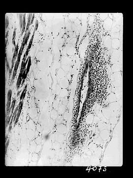 Fotomicrografia (miocardite) - Doença de Chagas (sequência 6 de 10)