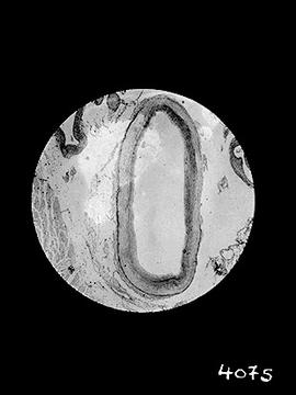 Fotomicrografia (miocardite) - Doença de Chagas (sequência 7 de 10)