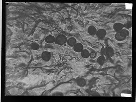 Fotomicrografia de corte histológico de lesão queloideforme
