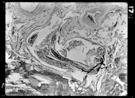 Fotomicrografia de gânglio linfático (corte) filariose