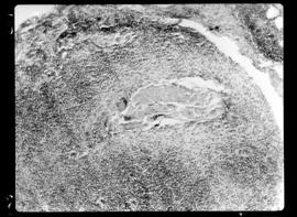 Fotomicrografia de gânglio linfático (corte) filariose