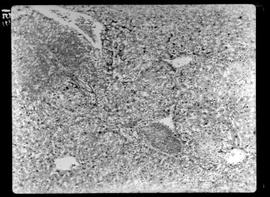 Fotomicrografia de Hanseníase experimental, infiltração do tecido interstical (trombos hialinos)
