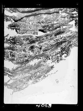 Fotomicrografia - Lâmina com Hanseníase (sequência 7 de 11)
