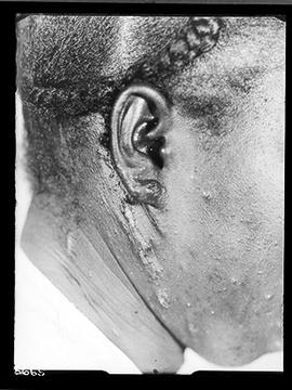 Doente - lesão na orelha