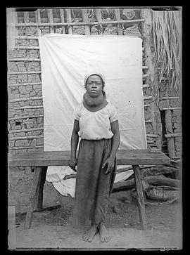 Menina de doze anos com moléstia de Chagas [bócio]
