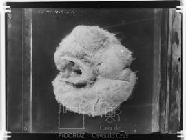 Peça anatômica - Bócio