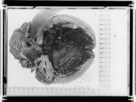 Peça anatômica - Coração de um portador de Doença de Chagas (Fotografia solicitada por Francisco ...