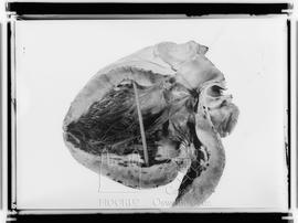 Peça anatômica - Coração de um portador de Doença de Chagas (Fotografia solicitada por Francisco ...
