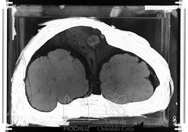 Peça anatômica (Carcinoma)