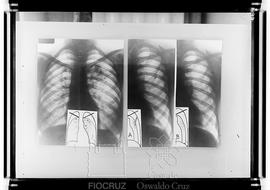 Reproducão de radiografias de pulmão (Fotografia solicitada por Milton Tiago de Melo)
