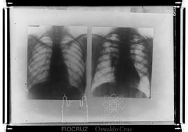 Reproducão de radiografias de pulmão (Fotografia solicitada por Milton Tiago de Melo)