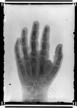 Reprodução de radiografia da mão de um portador da Doença de Chagas