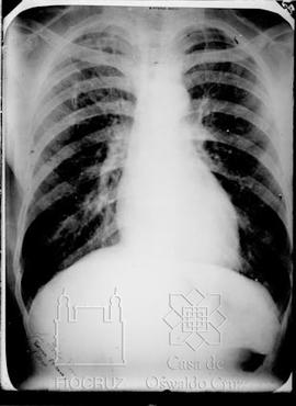 Reprodução de radiografia de portador da Doença de Chagas (Fotografia solicitada por Francisco da...