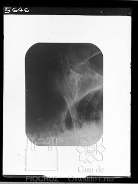 Reprodução de radiografia (Fotografia solicitada por Brenildo Tavares)