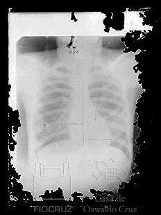 Reprodução de radiografia de tórax