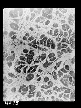 Fotomicrografia (miocardite) - Doença de Chagas (sequência 1 de 10)
