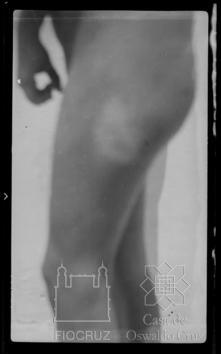 Leprosário de Água de Deus