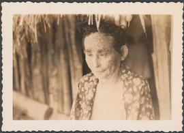 Aspectos do rosto de doente de pênfigo foliáceo em Camapuã